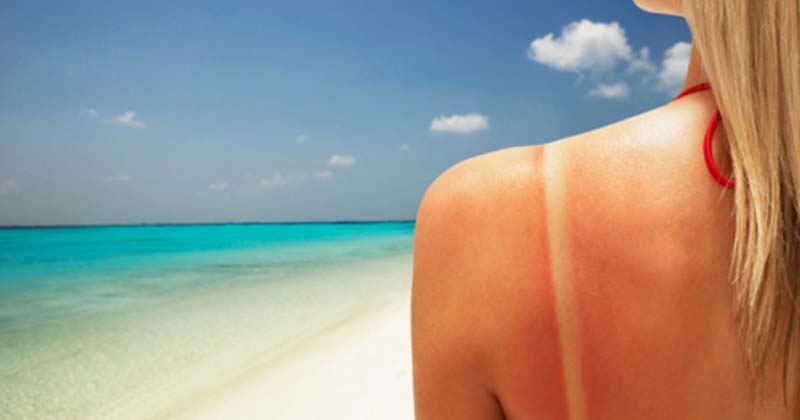 quemaduras de piel por el sol